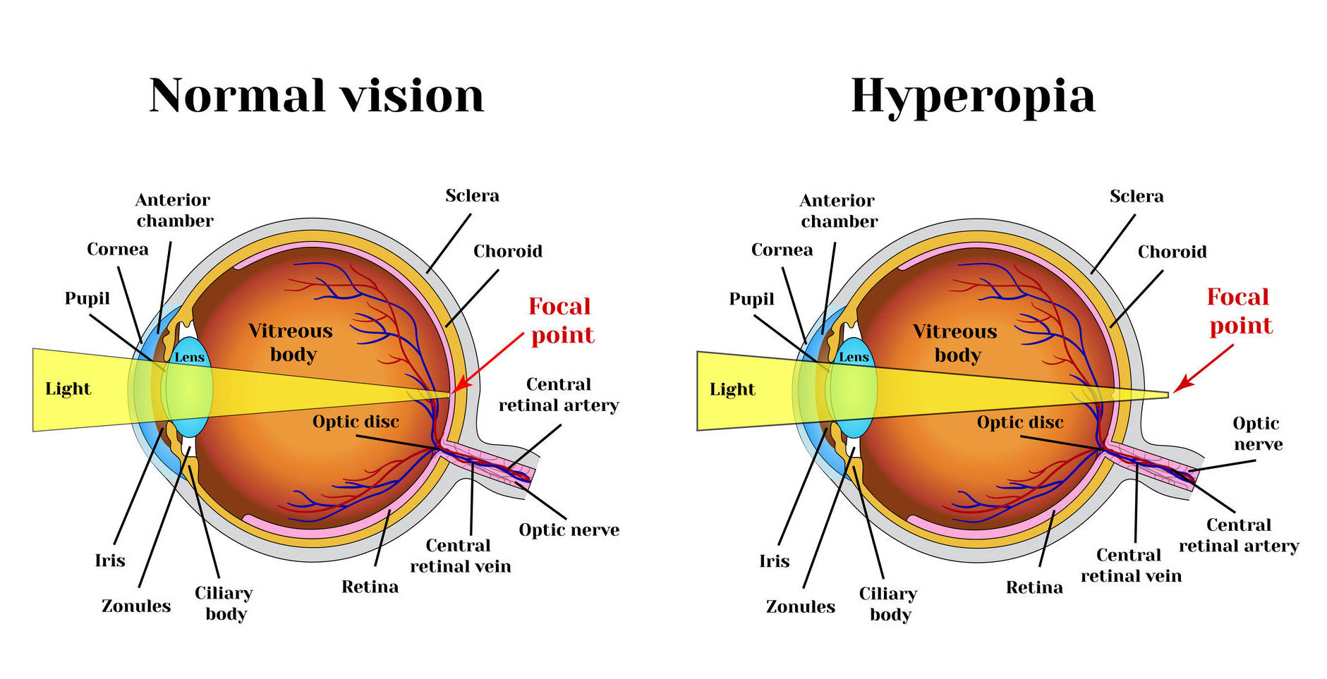 BatesEyeExercises Hyperopia Exercises