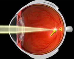 BatesEyeExercises.com === Vision disorders